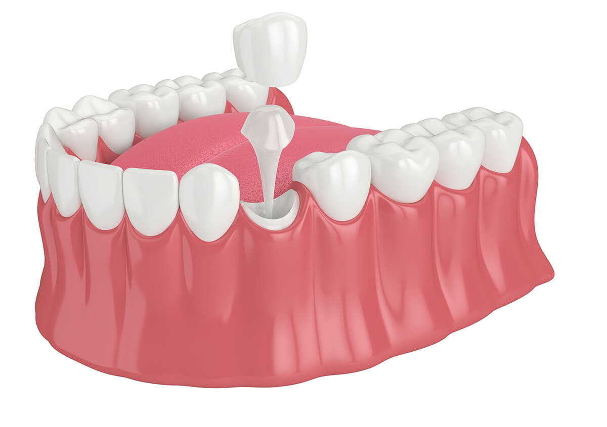 Teeth Crown Procedure in Centennial CO Area