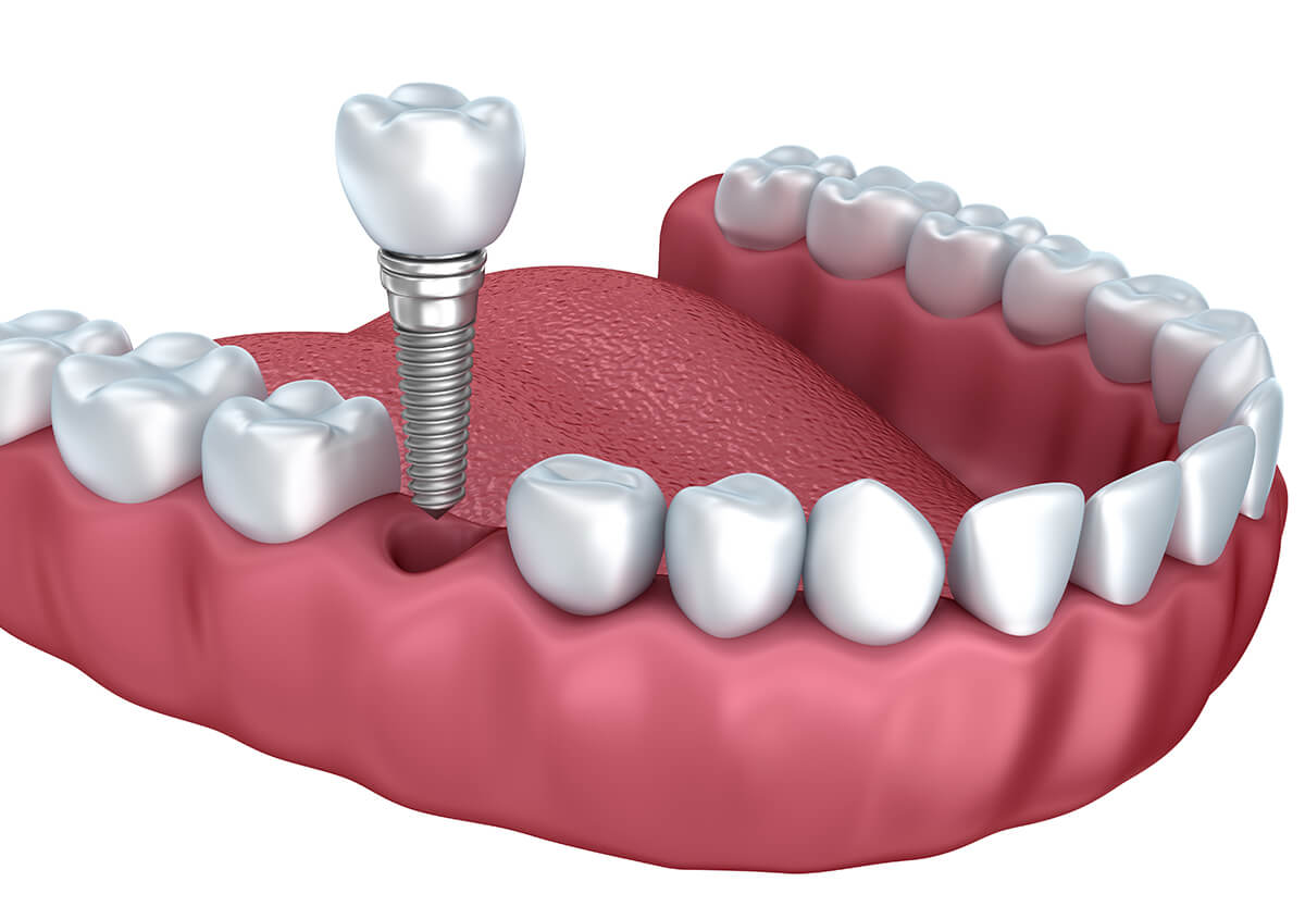 Teeth Implant Options in Centennial CO Area